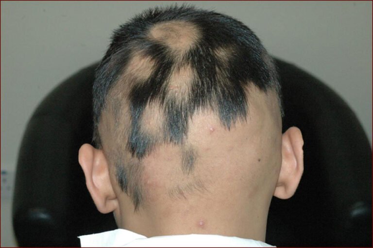 penyakit alopecia areata